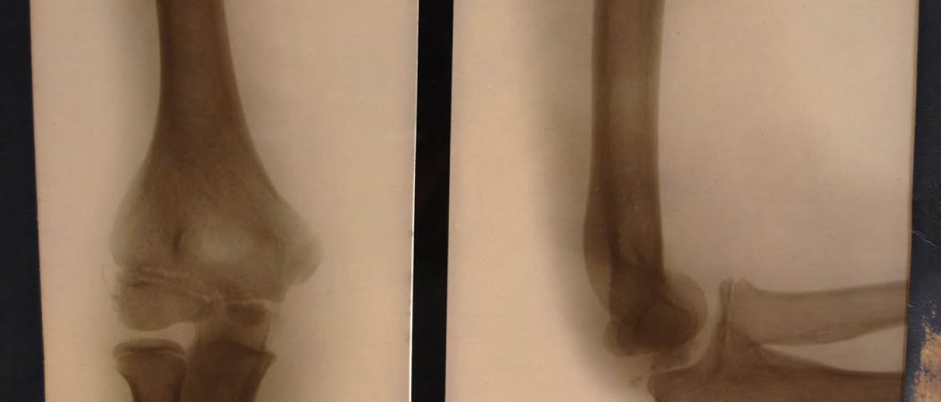 x-ray of elbow straight and bent