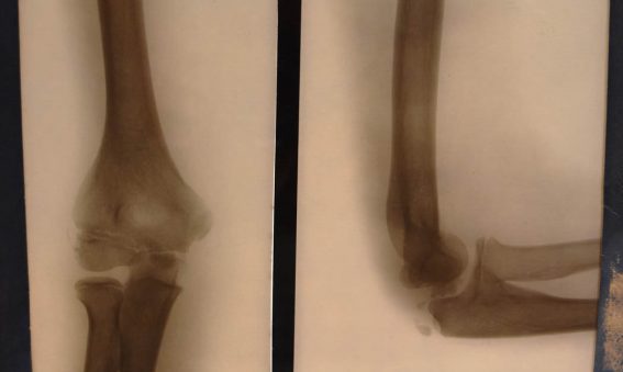x-ray of elbow straight and bent